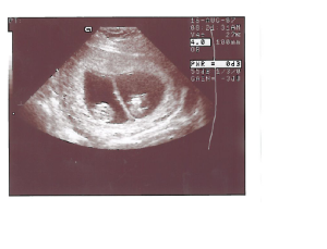 twins, in utero, twin babies